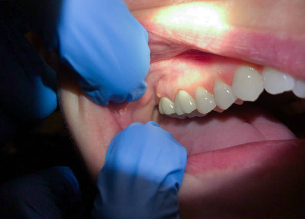 Best Emergency Dental Care for Sports Injuries in College Place, WA